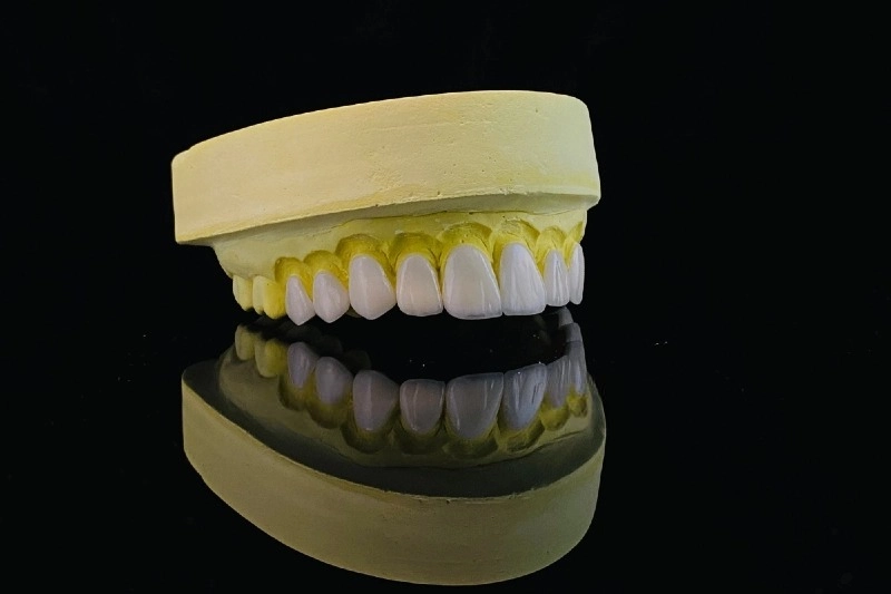 Nha khoa thẩm mỹ: Nâng cao nụ cười với Veneer và chất dẫn truyền ánh sáng