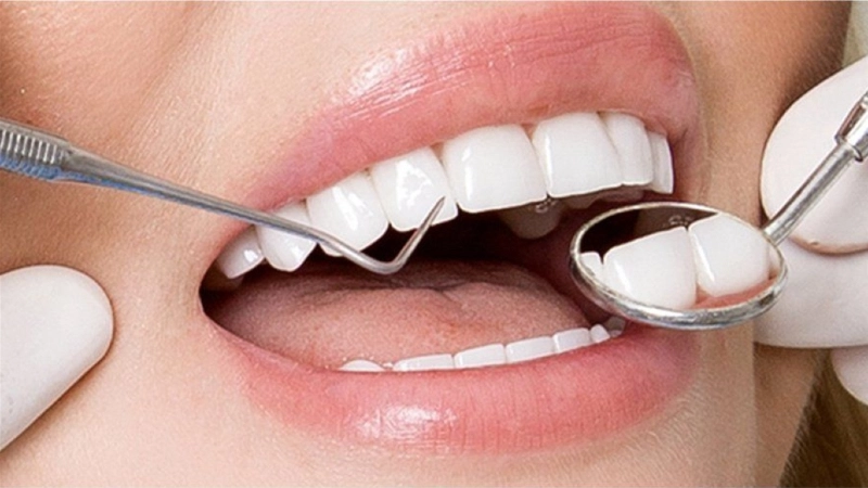 Cách vệ sinh răng sứ hàng ngày đúng cách